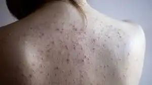 Mụn lưng có nên dùng dầu xả không? Nguyên nhân và cách khắc phục