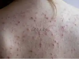 Mụn lưng có nên dùng dầu xả không? Nguyên nhân và cách khắc phục